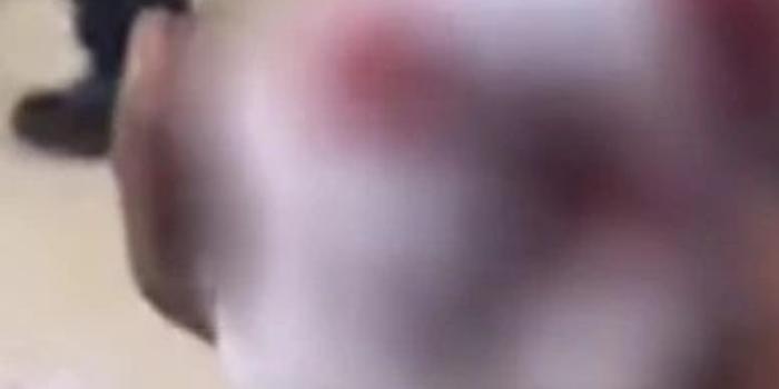 手指血流不断，手指血流不止是什么原因 