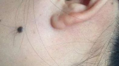 腋下突发 黑痣 疼，腋下痣有点疼怎么回事 